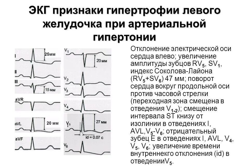 Очаговые изменения левого желудочка. Гипертрофия миокарда лж на ЭКГ. Критерии гипертрофии левого желудочка на ЭКГ. Гипертрофия желудочков на ЭКГ. Критерии гипертрофии миокарда левого желудочка ЭКГ.