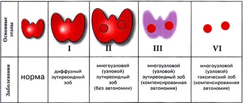 Диффузный нетоксичный. Диффузный многоузловой зоб степени. Диффузно-Узловой зоб 1 степени щитовидной железы. Узловой эутиреоидный зоб степени. Узловой нетоксический зоб классификация.