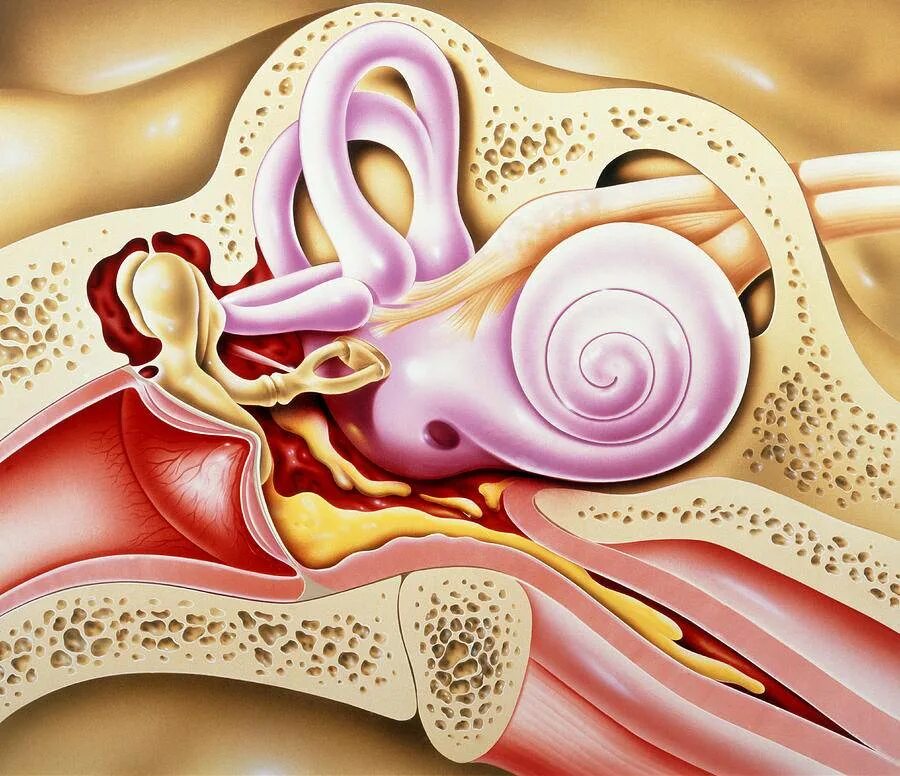 Почему трещит в ухе. Туботимпанальный отит. Правосторонний буллезный отит.