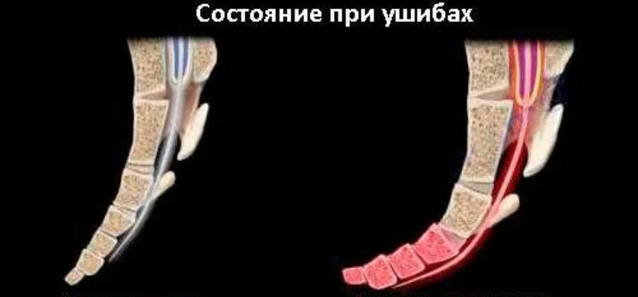 Копчик вверх. Перелом копчика со смещением.