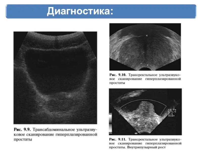 Хронический простатит аденома. УЗИ доброкачественная гиперплазия предстательной железы. ДГПЖ на УЗИ предстательной железы. УЗИ предстательной железы норма трансабдоминально.