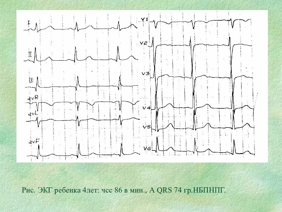 Экг ребенку 7 лет. Норма ЭКГ У детей 5 лет. ЭКГ расшифровка у детей 12 лет. Расшифровка ЭКГ У ребенка 1 год норма. QRS норма ЭКГ У ребенка 10 лет.