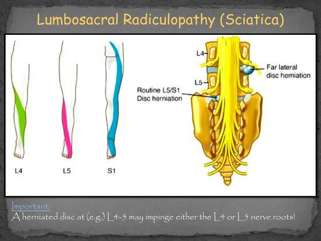 Радикулопатия l5 s1. Корешки л5 с1. Синдромы Корешков l5, s1. Корешок l4-l5. L5 корешок анатомия.