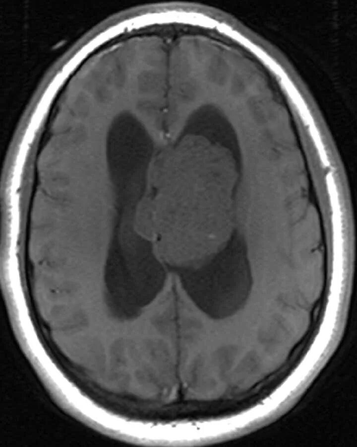 Опухоли желудочков. Эпендимома 4 желудочка мрт. Эпендимома головного мозга мрт. Эпендимома головного мозга кт. Эпендимомы боковых желудочков.