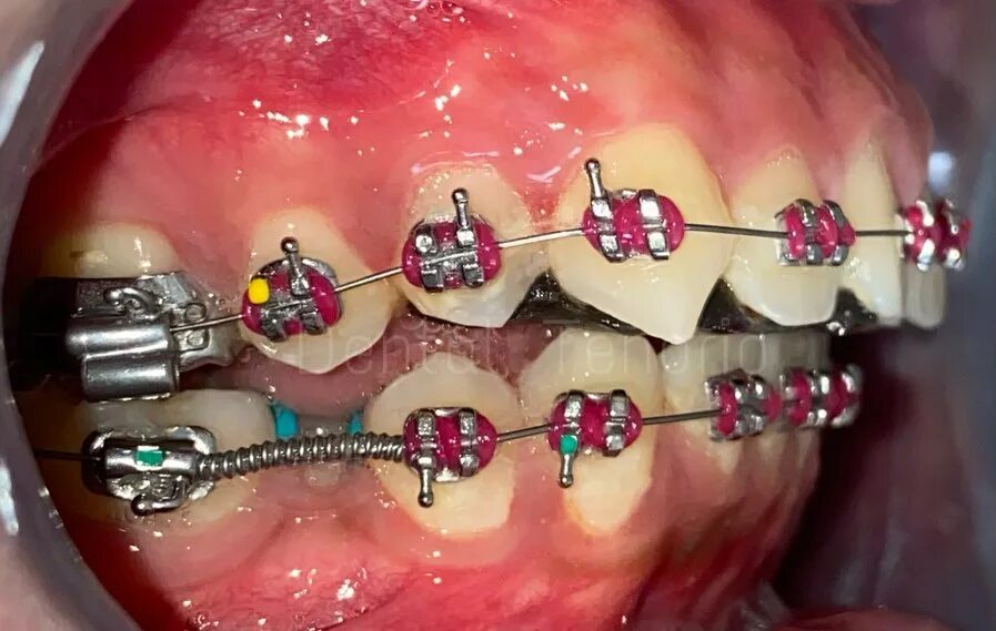 Se puede poner ortodoncia con implantes