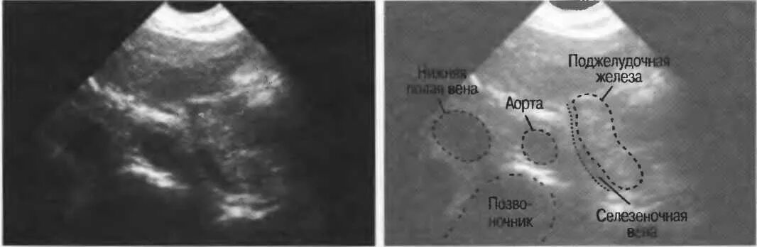 Кольцевидная поджелудочная железа УЗИ. Гиперэхогенные линейные включения в поджелудочной железе на УЗИ. Гиперэхогенное образование поджелудочной железы УЗИ. Кальцинаты поджелудочной железы УЗИ. Неравномерная диффузная