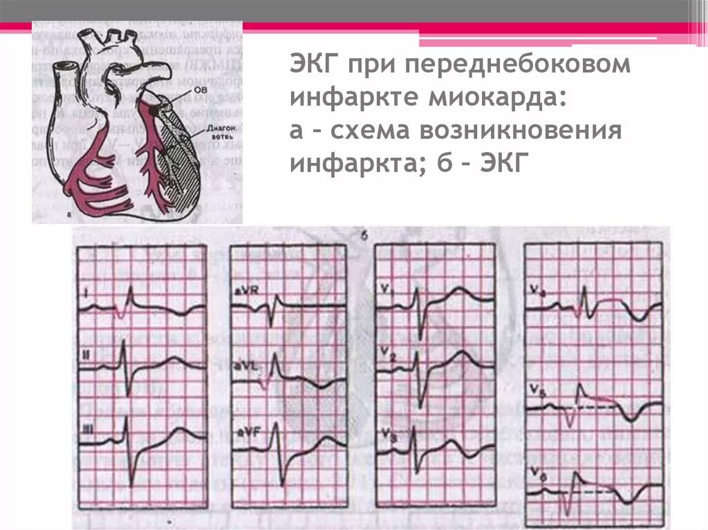 ЭКГ при переднебоковом инфаркте миокарда. Передней боковой инфаркт ЭКГ. Инфаркт переднебоковой стенки ЭКГ. ЭКГ передне перегородочный инфаркт.