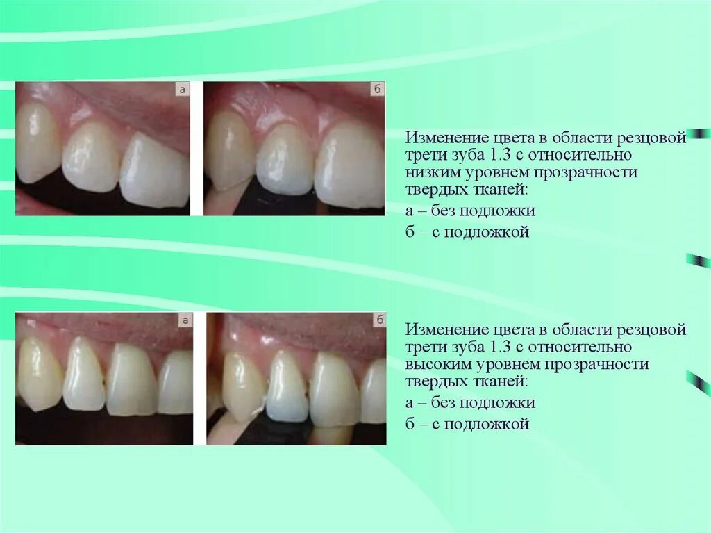 Смена тона. Причины изменения цвета зубов. Изменение цвета эмали зуба.