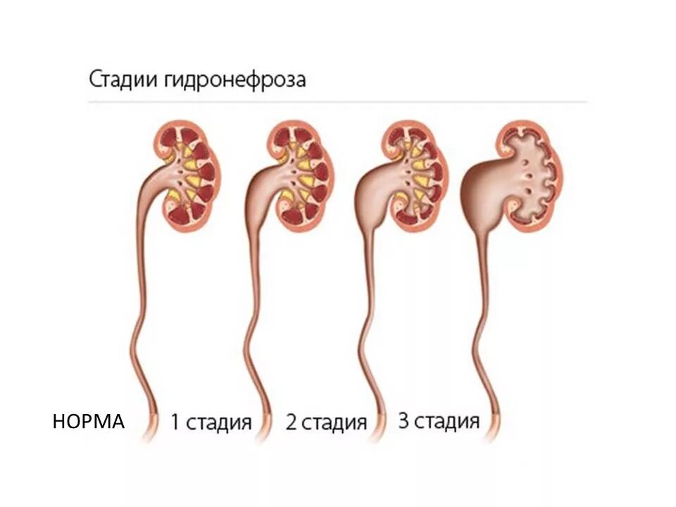 Гидронефроз почки 3 стадии. Строение почки гидронефроз. Гидронефроз 2-3 степени.