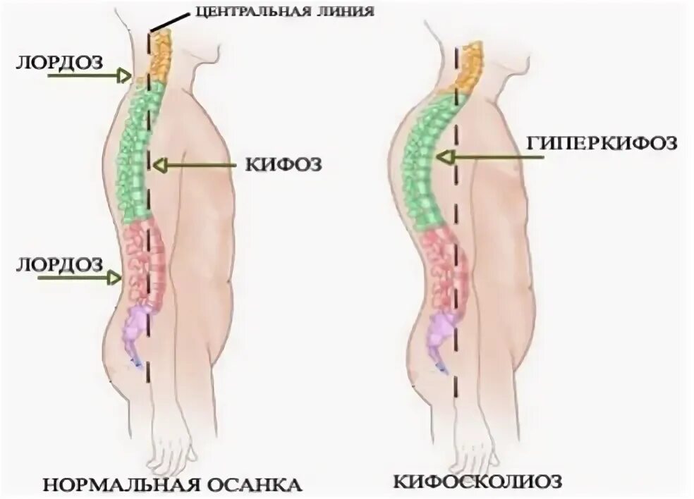 Искривление позвоночника у пожилых. Гиперкифоз грудного отдела. Степень искривления позвоночника кифоз. Лордоз грудного отдела позвоночника. Лордоз шейного отдела отдела.