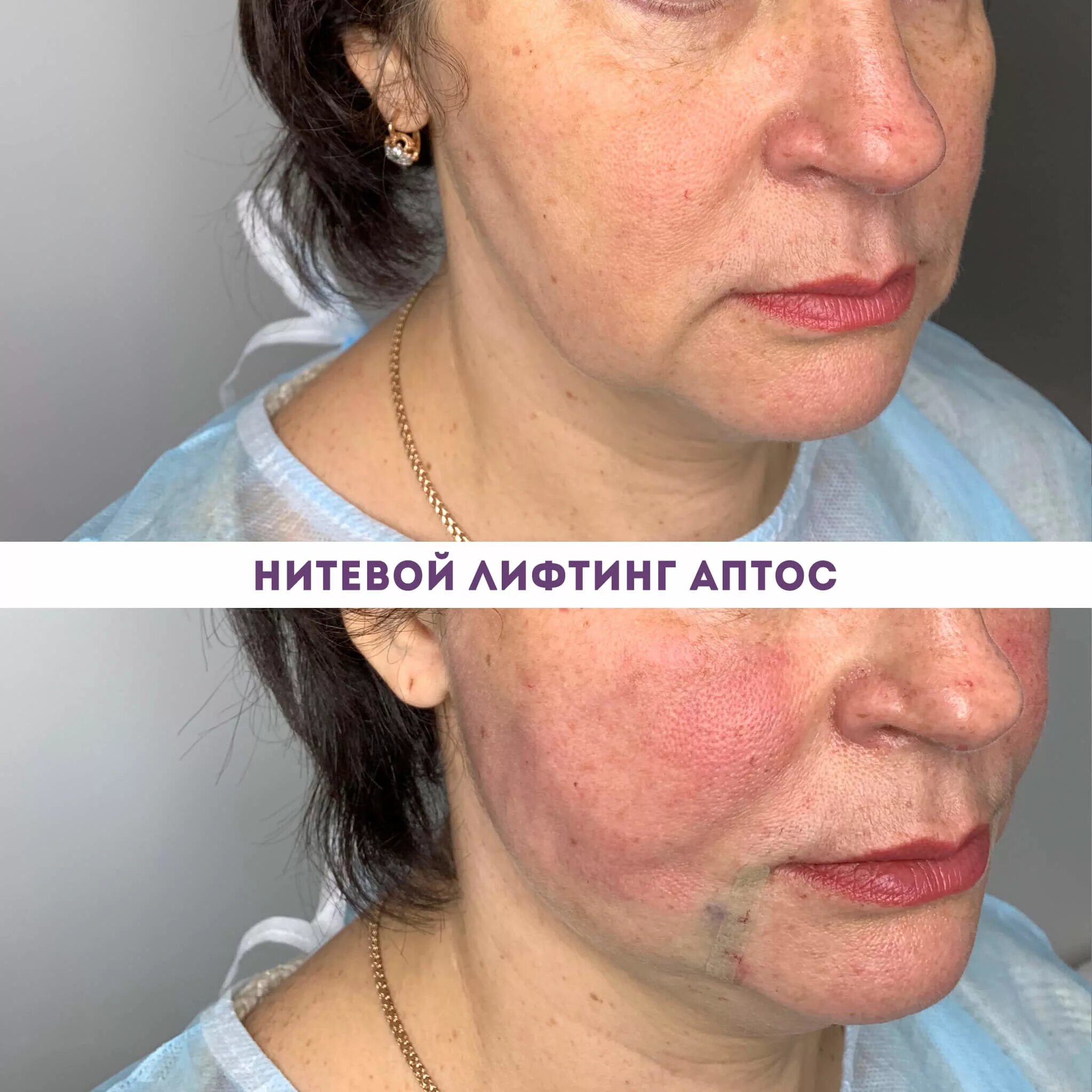 Aptos Excellence visage нитевой лифтинг. Нитевой лифтинг нитями Aptos (Light Life, visage, body, Needle 2g, Tread 2g). Нитевой лифтинг Elegance Aptos. Нити Аптос с полимолочной кислотой.