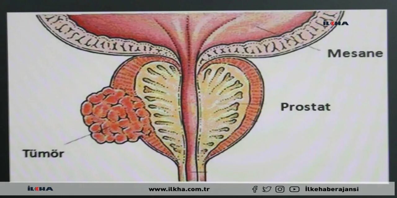 Ткани простаты. Предстательная железа у мужчин. Опухоль на предстательной железе. Простата и предстательная железа.