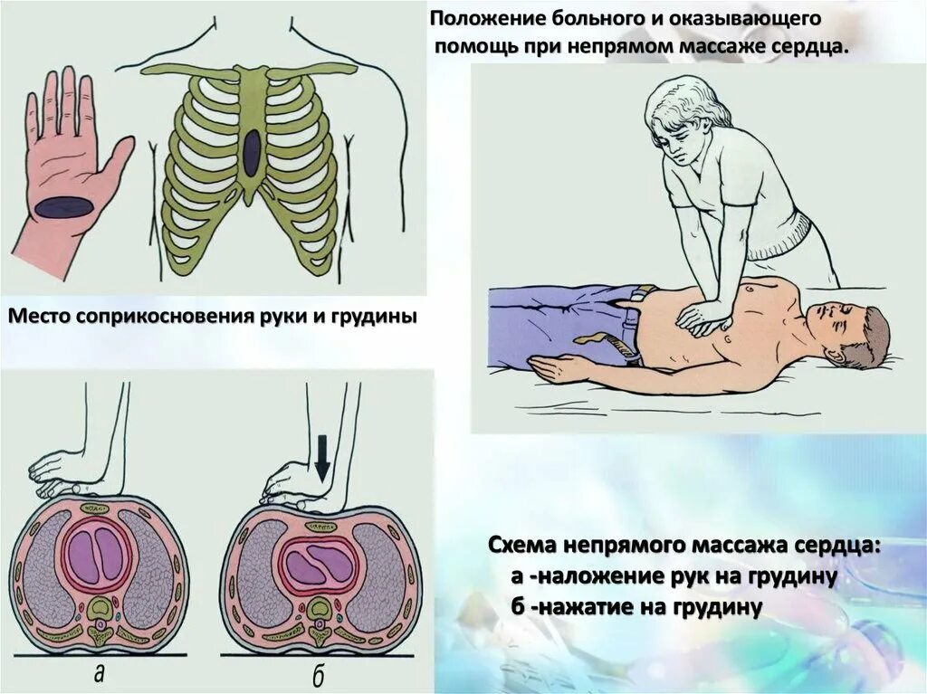 Частота надавливания при непрямом массаже. Схема проведения непрямого массажа сердца. Точка приложения рук при проведении непрямого массажа сердца. Непрямой массаж сердца техника выполнения. Непрямой массаж сердца этапы проведения.