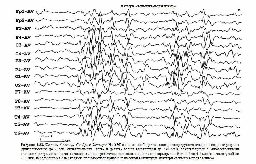 Эпилептические паттерны на ЭЭГ. Синдром Отахара на ЭЭГ. Гипсаритмия на ЭЭГ.