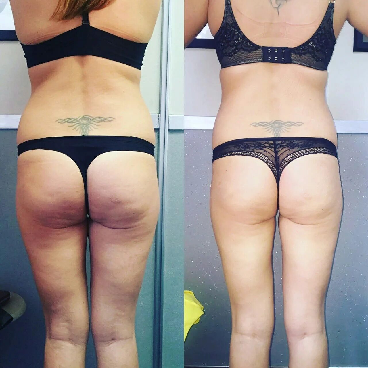 Антицеллюлитный массаж до и после. Липодистрофия целлюлит. До и после антицеллюлитного массажа. Аппаратный массаж до и после. До и после антицеллюлитного массажа.