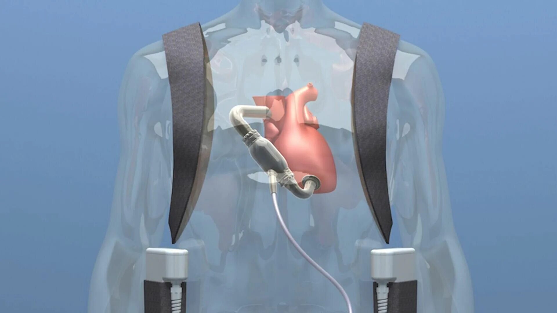 Искусственное сердце аппарат. Искусственные лёгкие аппарат. Аппарат вспомогательного кровообращения. Аппарат искусственного кровообращения насос.