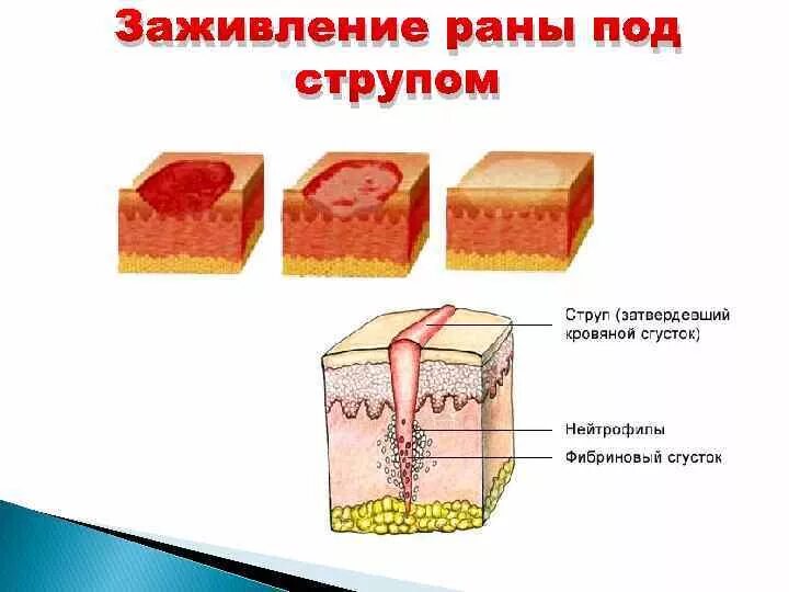 Стадии заживления после. Заживление РАН под струпом.