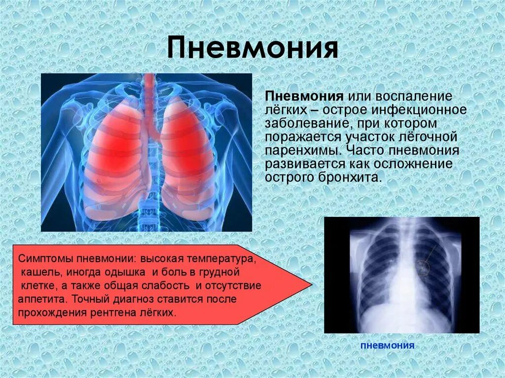 Вода в легких название