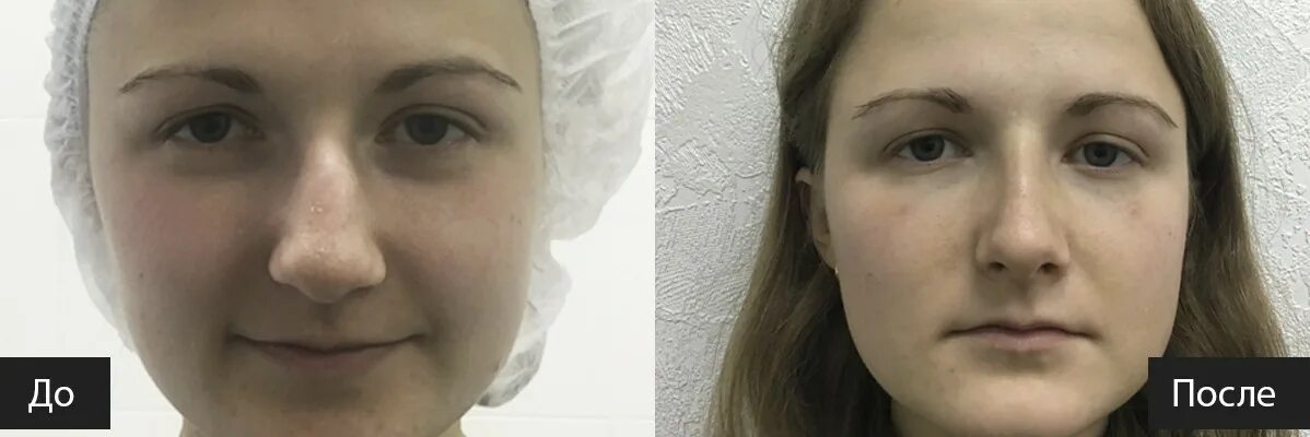 Сколько длится отек после операции. Септопластика после операции. ринопластика крыльев носа. септопластика до и после.