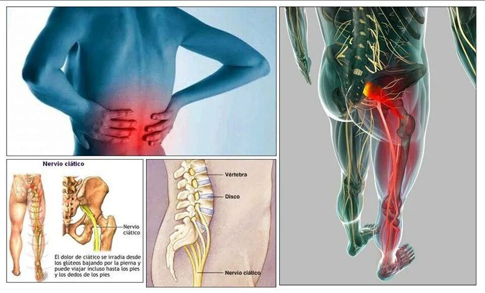 Болит нога от позвоночника. Люмбалгия поясничного крестцового отдела. Дорсопатия вертеброгенная люмбоишиалгия. Вертеброгенная люмбоишиалгия болевой синдром. Люмбоишиалгия пояснично-крестцового отдела.