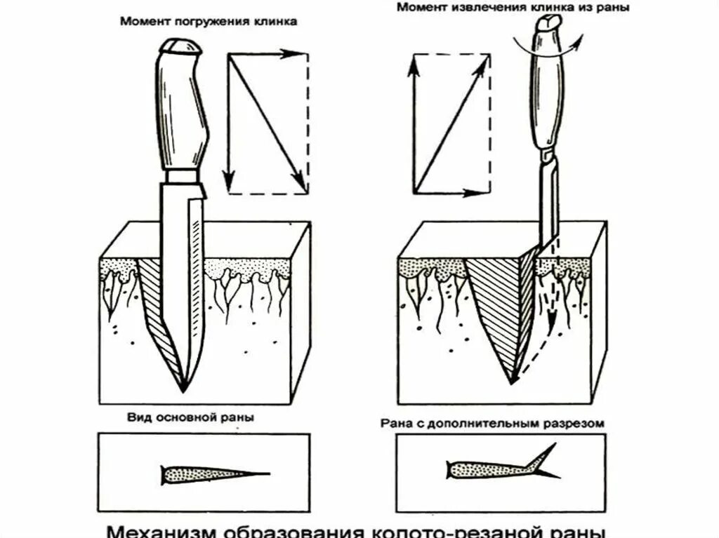 Механизм травмы колото резаных РАН. Резаная рана судебная медицина. Колото-резаная рана судебная медицина. Колото резаная рана рана судебная медицина.