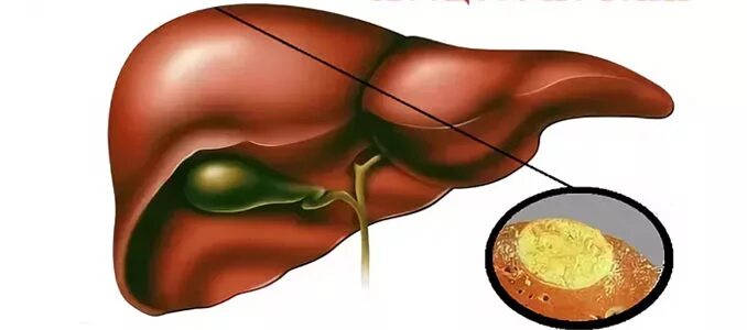 Гепатит желчный пузырь. Холангиогенные абсцессы печени. Амебиазный абсцесс печени. Билиарный абсцесс печени. Эхинококкоз абсцесс печени.