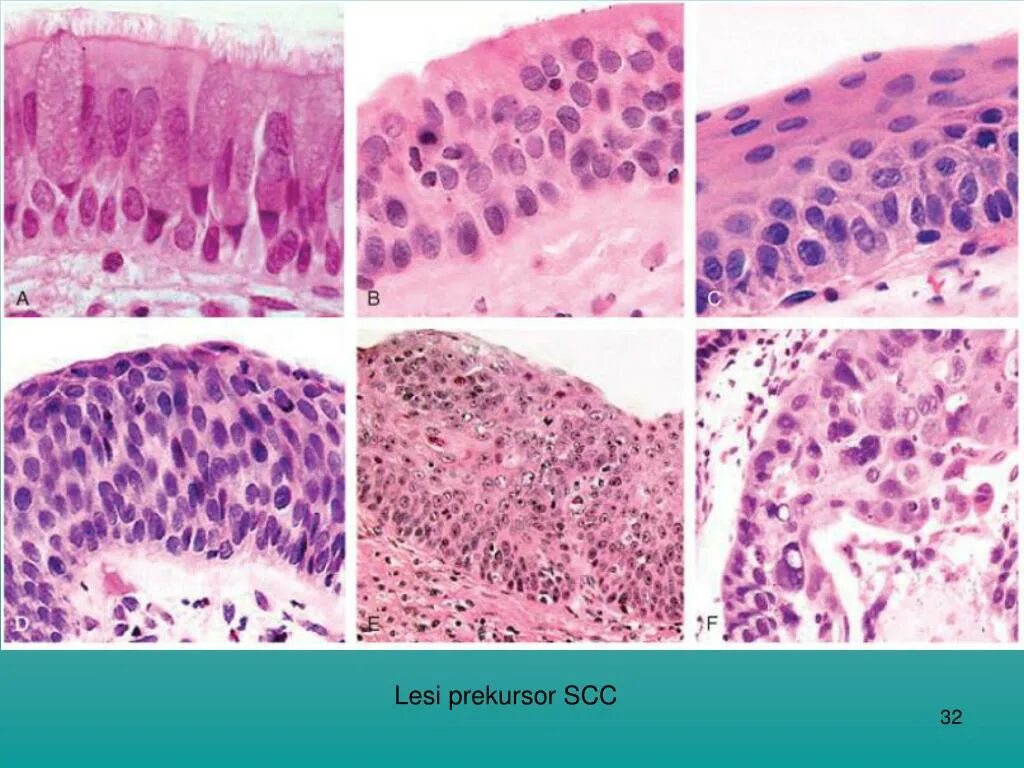 Squamous Cell carcinoma гистология. Плоскоклеточная карцинома легкого гистология. Бронхогенная карцинома гистология. Клетки бронхов гистология. Стадии рака легких плоскоклеточный