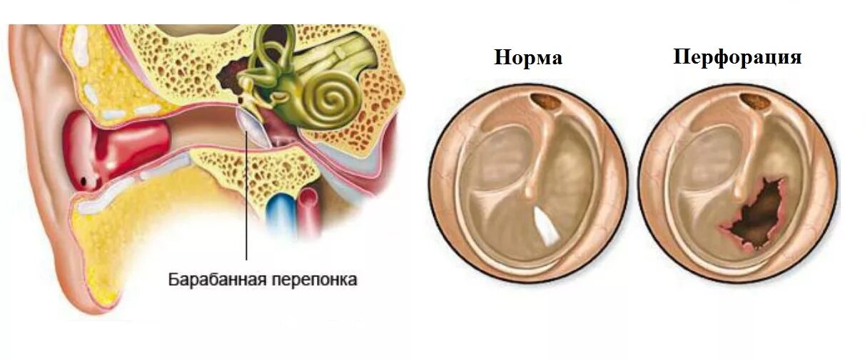 Натянутая барабанная перепонка. Гнойный отит с перфорацией. Мезотимпанит барабанная перепонка.