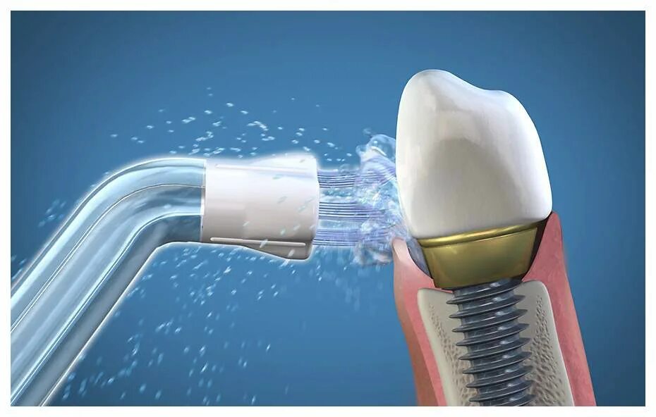 Ирригатор насадка для имплантов