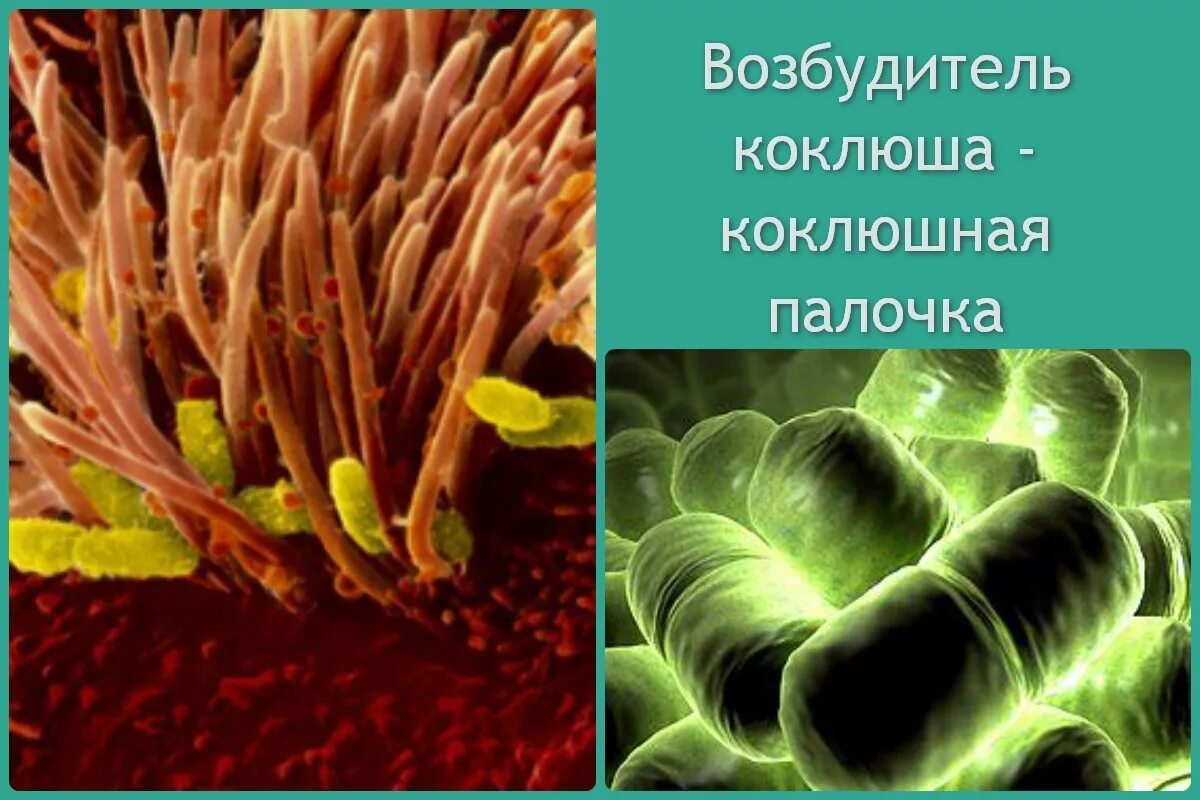 Коклюш бактериальная. Бактерия возбудитель коклюша. Палочка коклюша бактерия. Коклюш возбудитель болезни. Коклюш палочка борде Жангу.