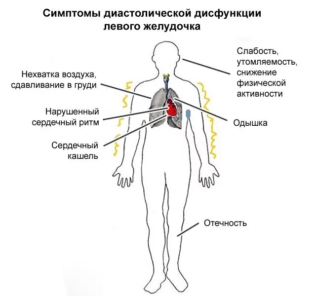 Нарушение диастолической функции левого желудочка по 1. Типы нарушения диастолической функции лж. Диастолическая дисфункция левого желудочка 1. Дисфункция лж 2 типа. Диастолическая дисфункция левого желудочка 1 типа что это такое.