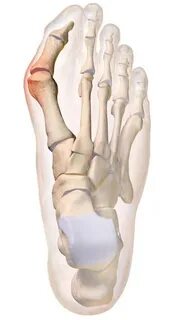 Hallux valgus фото москва