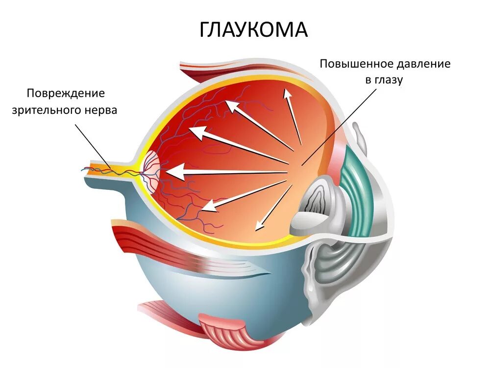 Повышение внутриглазного давления (глаукома).. Глазное давление высокое это глаукома.