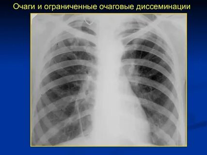 Очаг в грудине