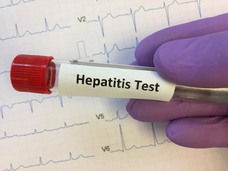 Тест на гепатит с купить. Тест на гепатит с в аптеке. Пробирка на гепатит. HCV тест. Экспресс-тест на гепатит в.