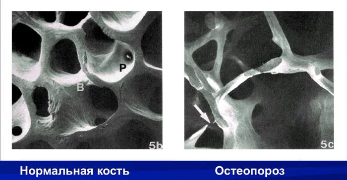 Структурные изменения костей. Остеопороз костей на кт. Пятнистый остеопороз на рентгенограмме. Остеопороз кости на рентгенограмме. Костная ткань при остеопорозе на рентгене.