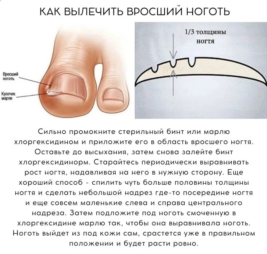 Как правильно стричь вросший ноготь. Операции при вросшем ногте. вросший ноготь начальная стадия.