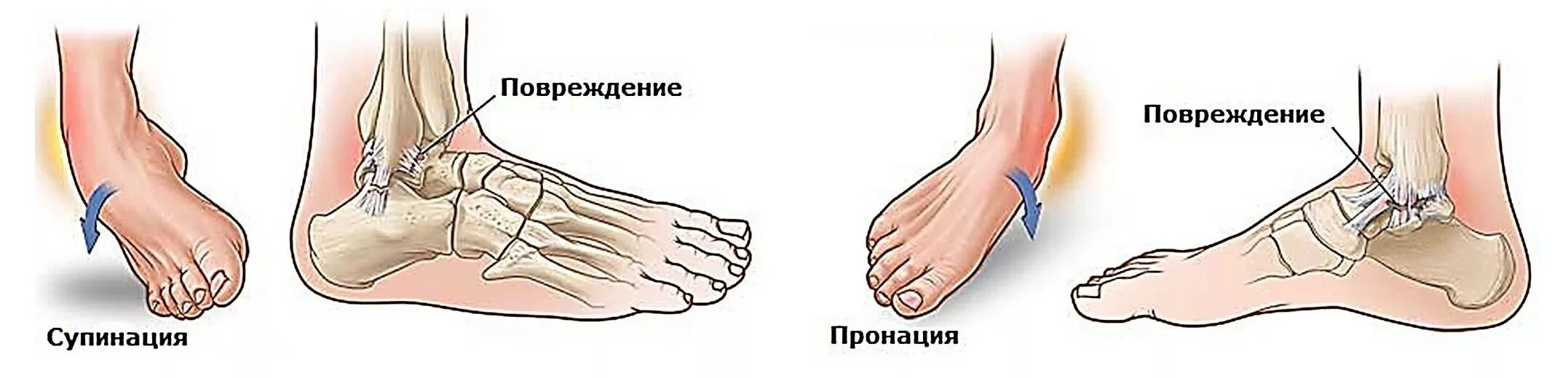 Сколько срастается стопа