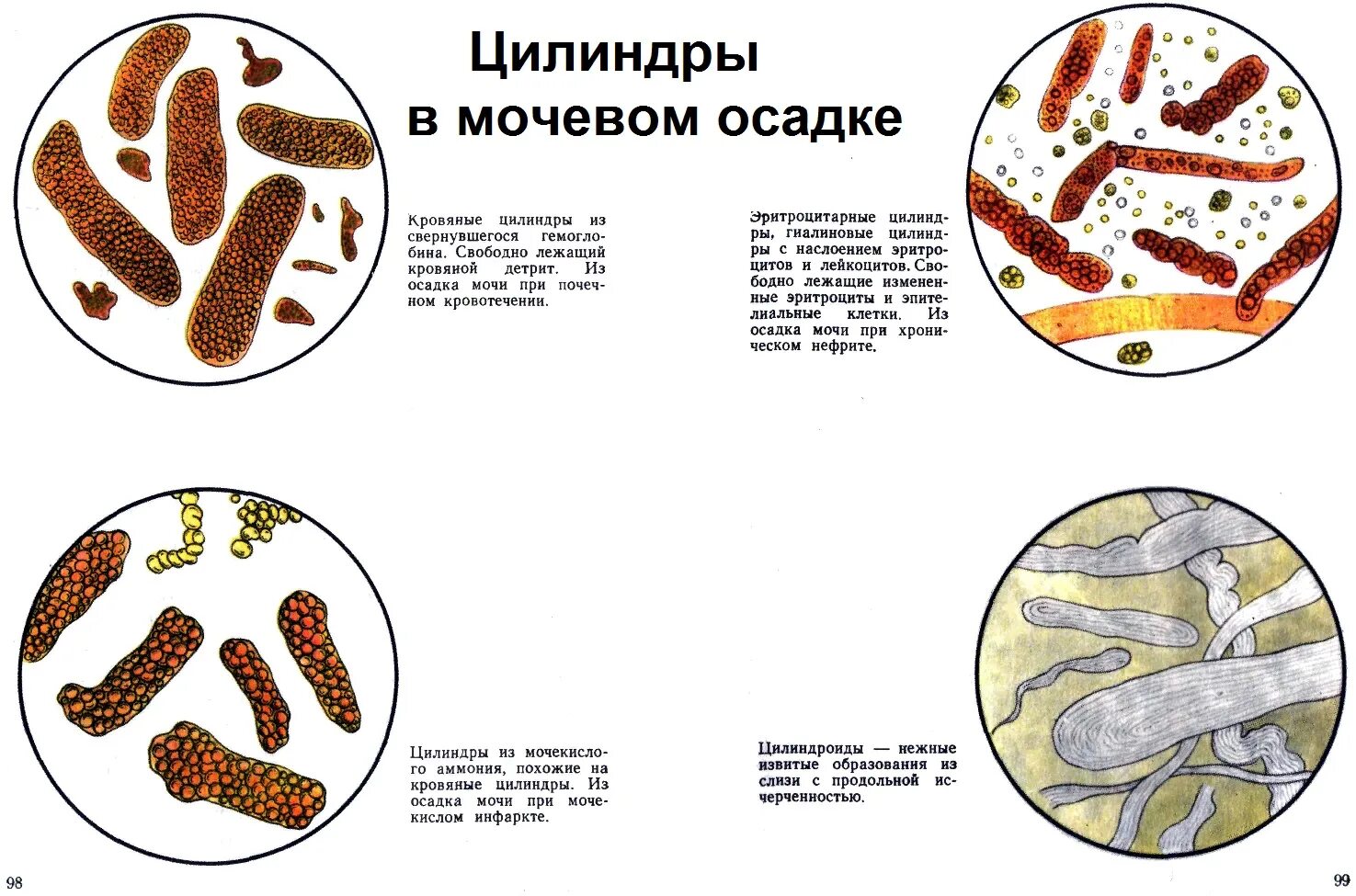 Слизь в осадке мочи. Микроскопия мочи норма микроскопия осадка. анализ мочи с микроскопией осадка. микроскопическое исследование осадка мочи норма. слизь в моче микроскопия.