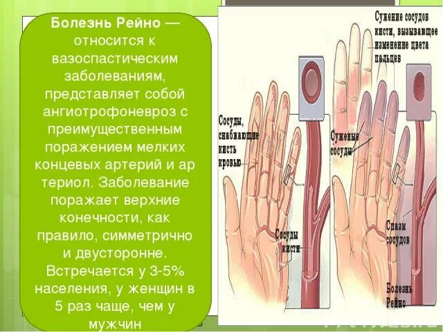 Синдром Рейно стадии болезни. Феномен Рейно и синдром Рейно. Синдром Рейно этиология. Вазоспастический синдром Рейно. Синдром рейно это простыми словами