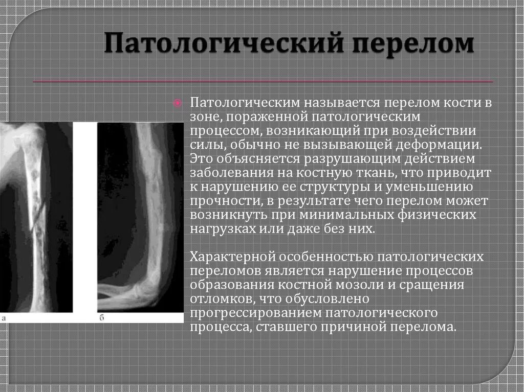 Трещина симптомы лечение. Рентгенограмма патологический перелом бедра. Метастазы в бедренной кости рентген. Патологический перелом бедренной кости метастазы. Патологический перелом остеомиелит бедра.