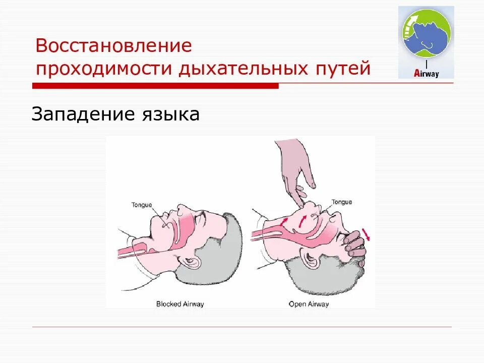 Восстановление проходимости дыхательных путей. Восстановление проходимости дыхательных путей при западении языка. Восстановление проходимости дыхательных путей у детей. Предотвращение западения языка. Проверка проходимости дыхательных путей