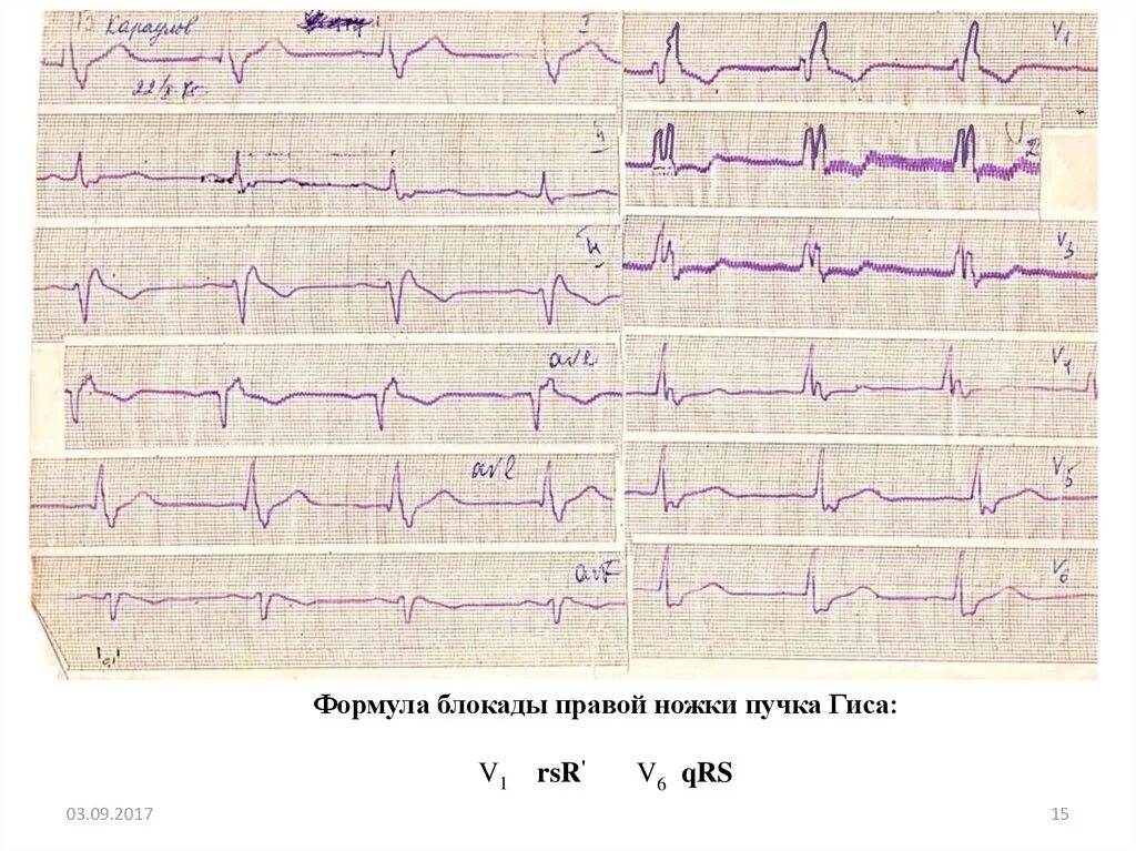 Что означает блокада правой ножки. Формула блокады правой ножки пучка Гиса. Блокада правой ножки Гиса v1. Блокада ножек пучка Гиса RSR. Комбинированная блокада ножек пучка Гиса.