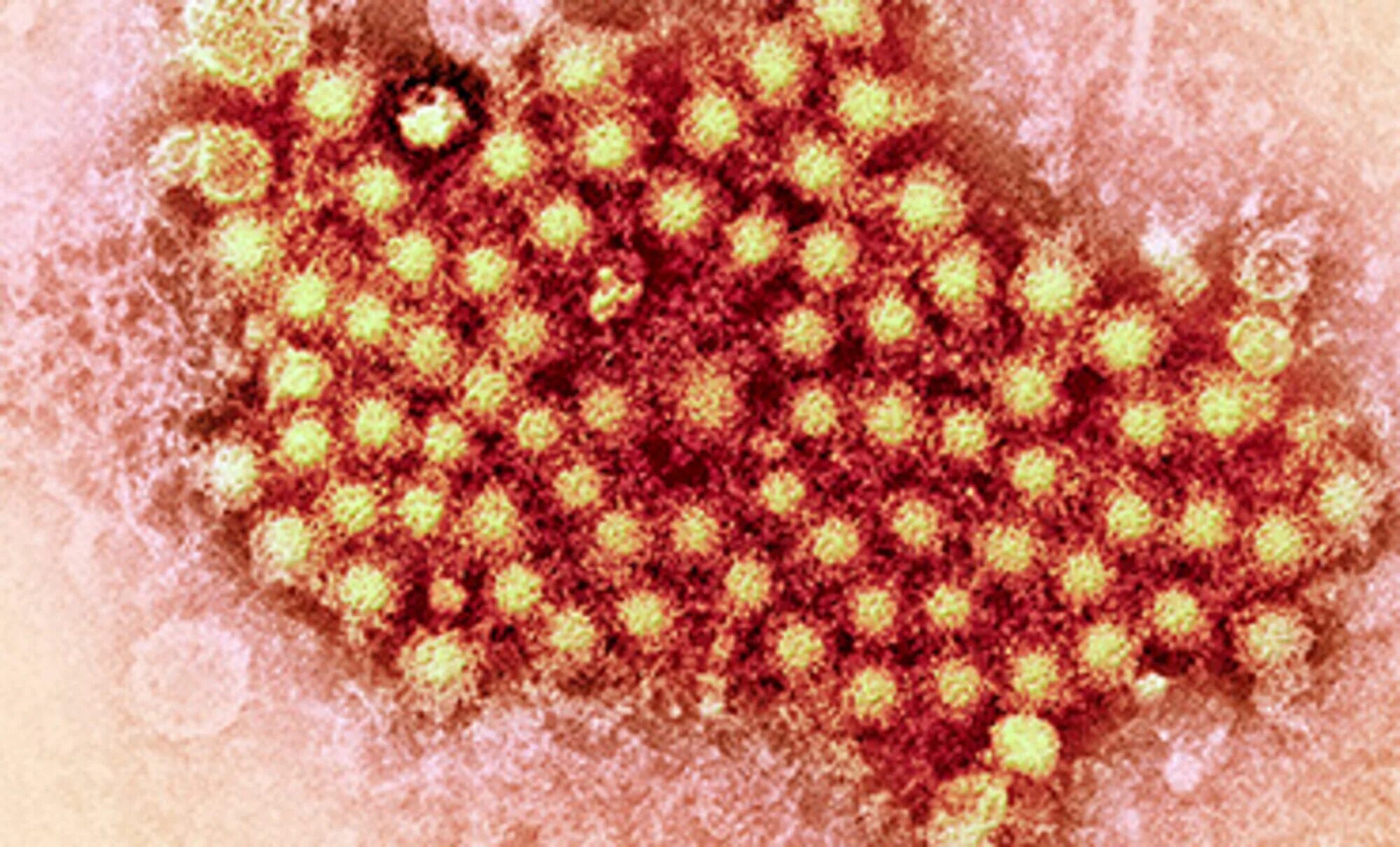 Энтеровирус под микроскопом. Энтеровирусная пузырчатка. Ротавирус энтеровирус Коксаки. Кишечные инфекции вирусный гепатит
