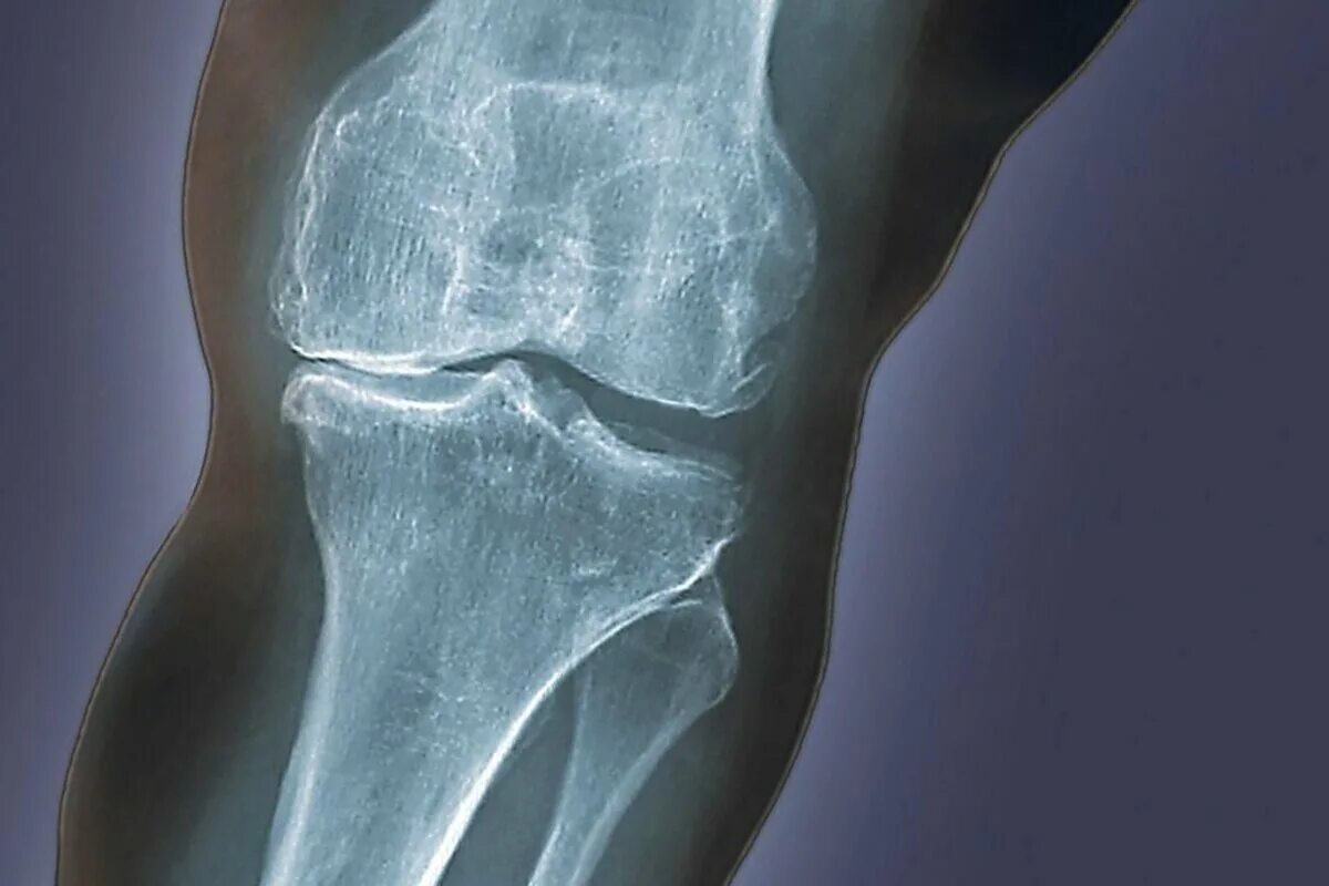 Остеоартрит коленного сустава