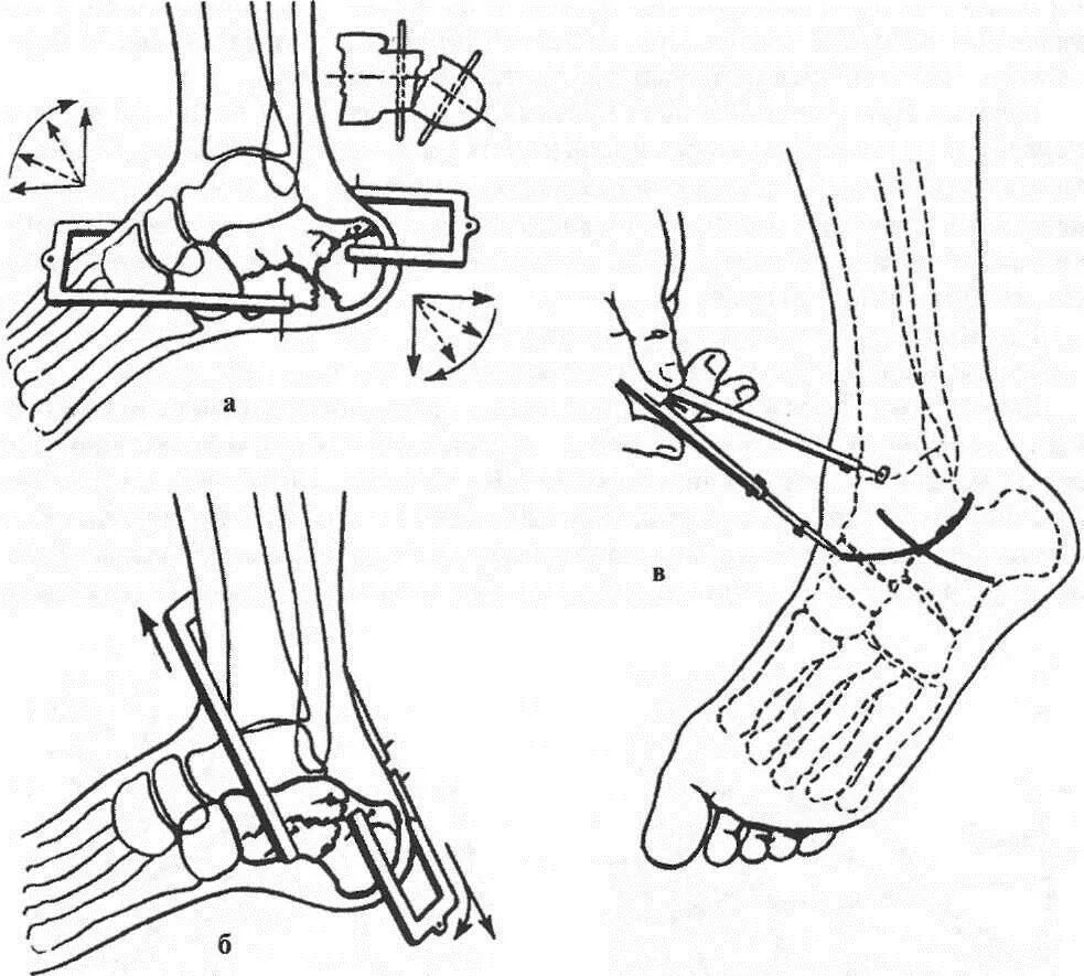 Операция пяточной кости. Скелетное вытяжение при переломе пяточной кости. Перелом пяточной кости репозиция. Репозиция перелома лодыжек. Репозиция костных отломков.
