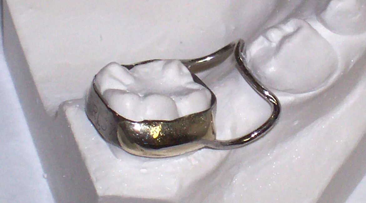 ретенционная каппа несъемная. кольцо на молочный зуб. ортодонтический аппарат норда. кольцо на молочный зуб. аппарат кольцо петля ортодонтия.