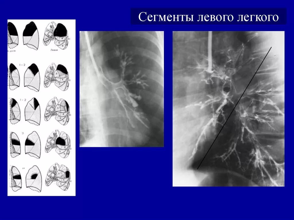 Субплевральные отделы легких