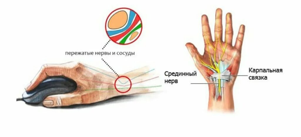 Онемение пальцев после операции. Туннельный синдром лучезапястного сустава. Синдром карпального канала кисти. Карпальный синдром запястья. Синдром туннельного канала запястья.