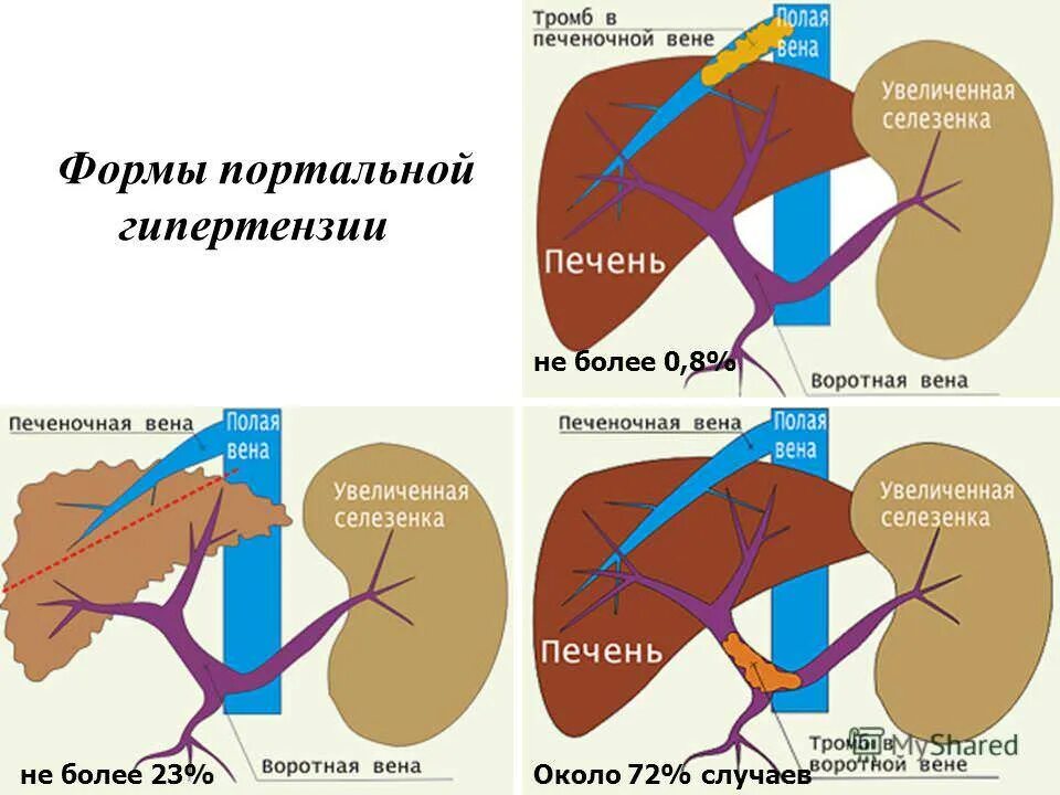 Расширение селезеночных вен. Синдром портальной гипертензии схема. Постпеченочная (надпеченочная) портальная гипертензия:. Печеночная форма портальной гипертензии. K76.6 портальная гипертензия.